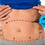 Liposuction Nedir ve Sonrasi Korse Kullanimi