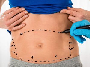 Liposuction Nedir ve Sonrasi Korse Kullanimi