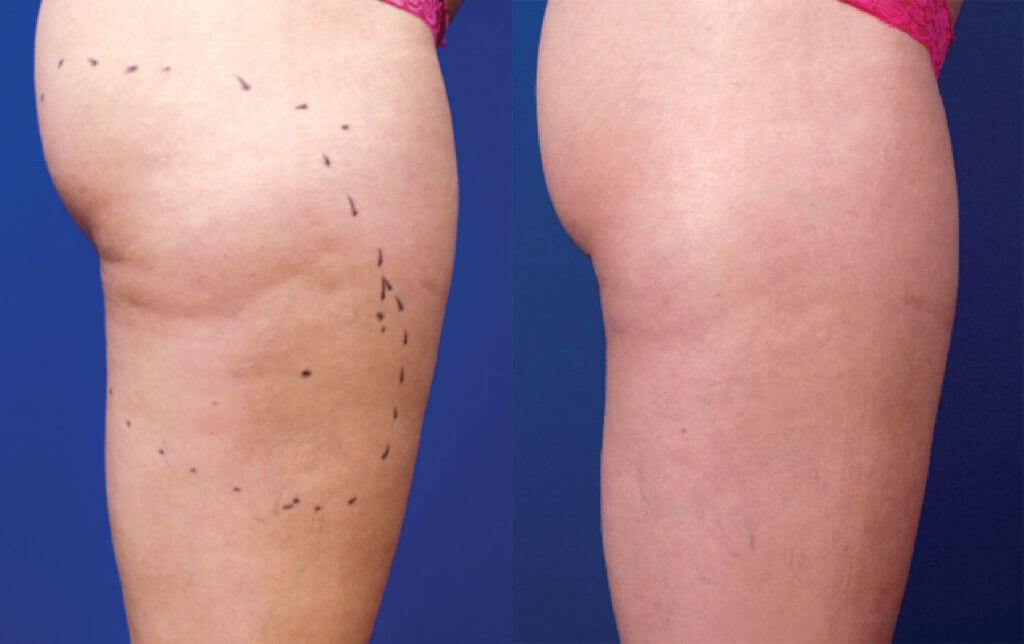 Ultrasonik Liposculpting